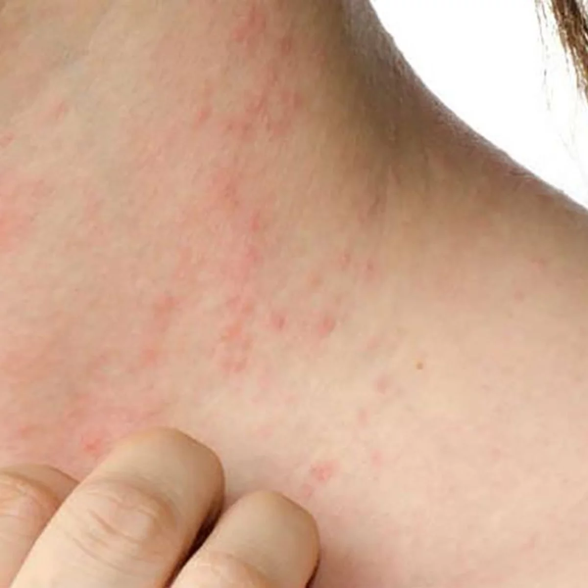 Dermatitis Atópica Cómo Es La Enfermedad Que “pica Todo El Tiempo